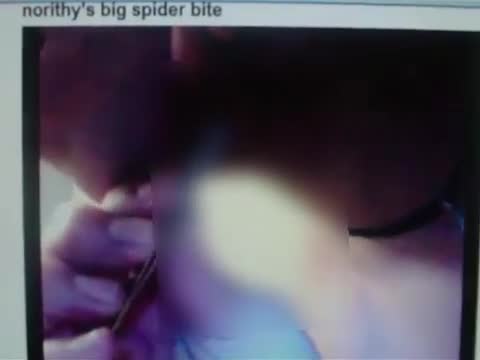 norithy's big spider bite CENSORED